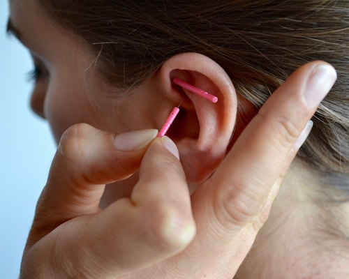 Ear Acupuncture treatment at Refined Health & Wellness in St. Albert