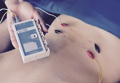 Electroacupuncture set up with wires clipped to acupuncture needles