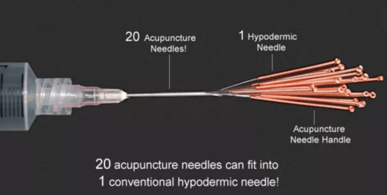 20 acupuncture needles inserted into the tip of one hypodermic needle
