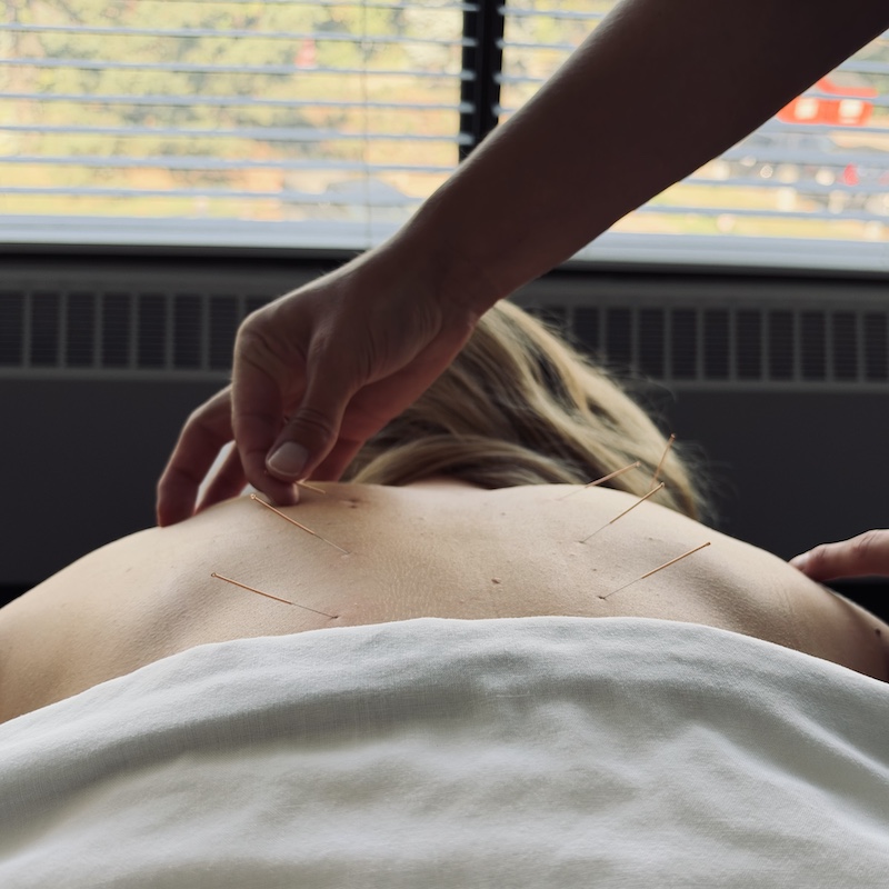 Refined Health & Wellness | Acupuncture | Dr. Bentley Van Beek | Back Acupuncture 2
