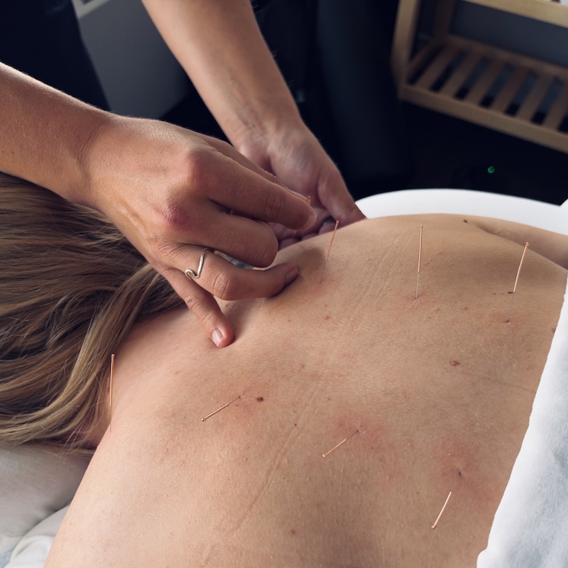 Refined Health & Wellness | Acupuncture | Dr. Bentley Van Beek | Back Acupuncture