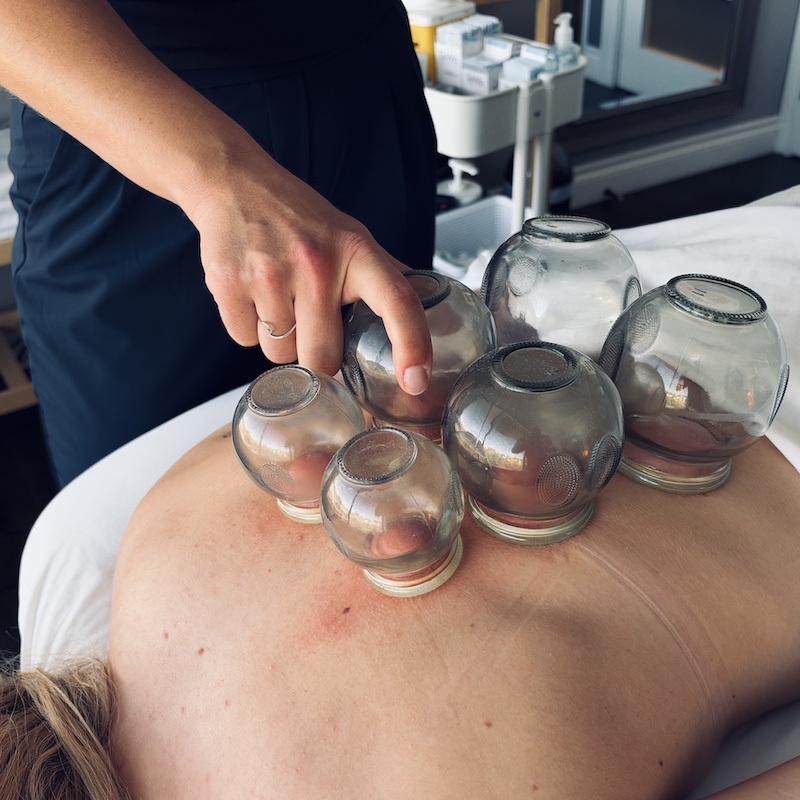 Refined Health & Wellness | Acupuncture | Dr. Bentley Van Beek | Fire Cupping