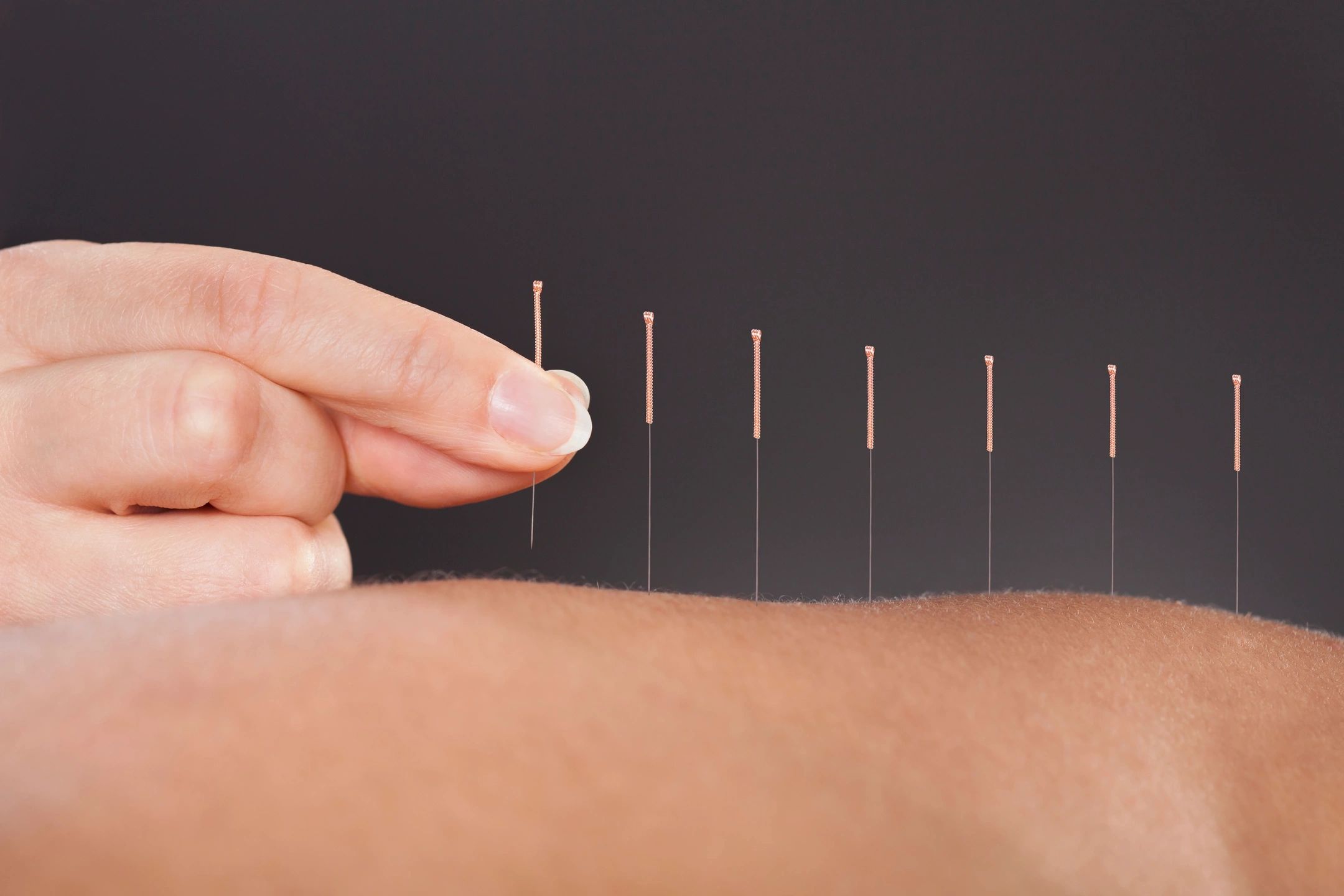 Acupuncture Needling