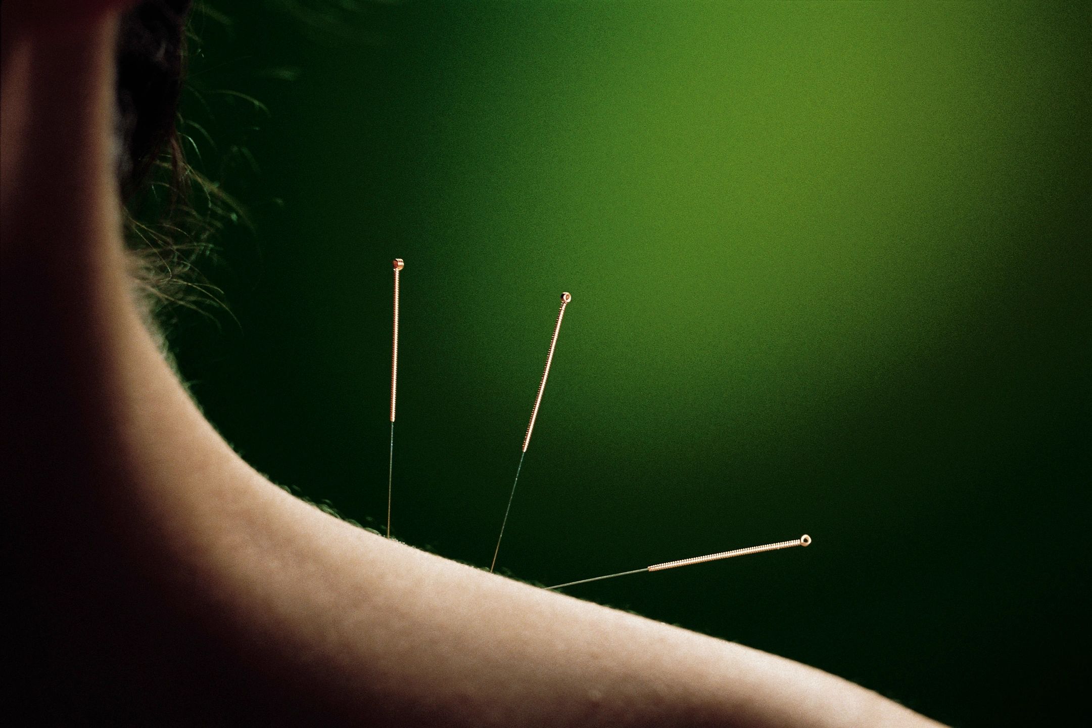Preventative Acupuncture